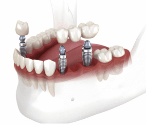 Dental Implant